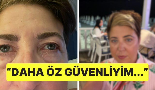 goz-alti-torbalarindan-utandigi-icin-ameliyat-olmaya-karar-veren-bayanin-son-hali-sasirtti-gFgitL8i.jpg