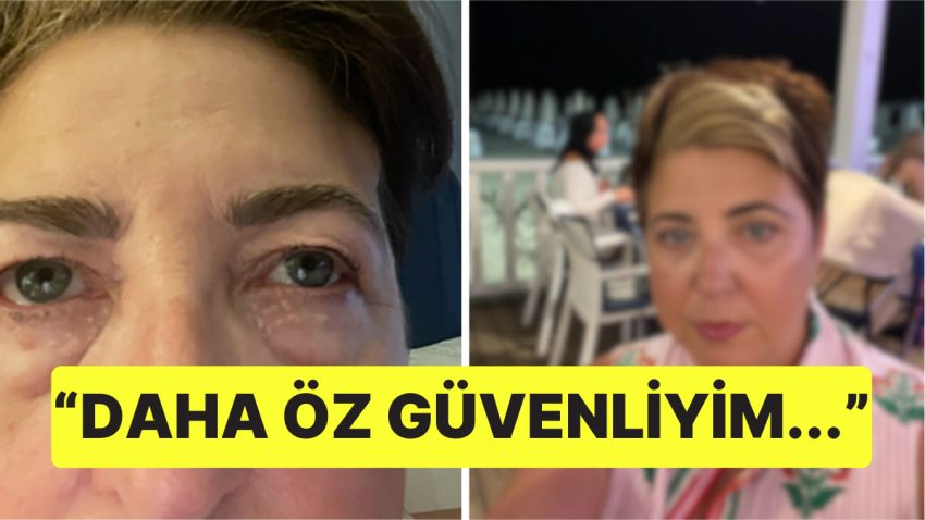 Göz Altı Torbalarından Utandığı İçin Ameliyat Olmaya Karar Veren Bayanın Son Hali Şaşırttı