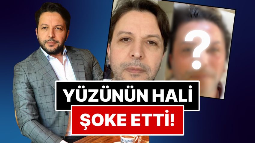 Yüzünü Görenler Şoke Oldu: Kaşlarına Süreç Yaptıran Nihat Doğan’ın Son Hali Tatları Üzücü Halde Kaçırdı!