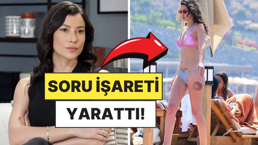 Deniz Dönemini Açan Müjde Uzman’ın Bacağındaki Büyük Morluk Merak Uyandırdı!