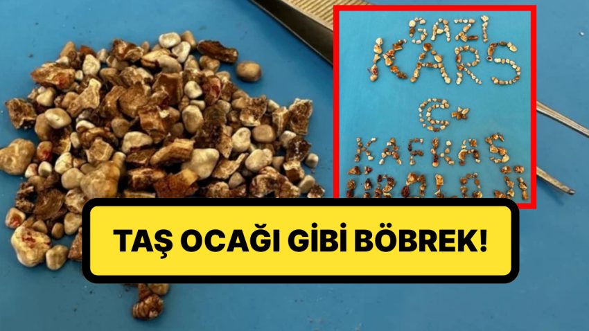 Taş Ocağı Üzere Böbrek: Bir Hastanın İki Böbreğinden 300’ün Üzerinde Taş Çıktı