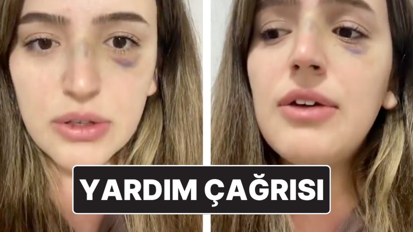 Eşinden Şiddet Gören Bayanın Yardım Daveti: “Lütfen Sesim Olun”