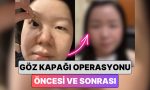 guney-korede-bir-bayan-en-yaygin-estetiklerden-biri-olan-goz-kapagi-operasyonu-ile-yasadigi-EPIeAHwa.jpg