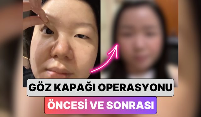 guney-korede-bir-bayan-en-yaygin-estetiklerden-biri-olan-goz-kapagi-operasyonu-ile-yasadigi-EPIeAHwa.jpg