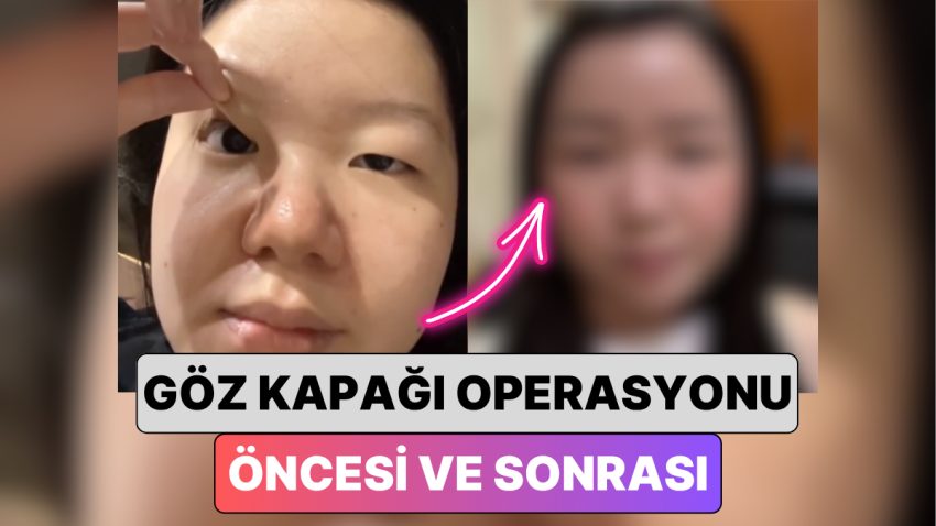 Güney Kore’de Bir Bayan En Yaygın Estetiklerden Biri Olan Göz Kapağı Operasyonu ile Yaşadığı Değişimi Paylaştı