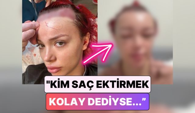 biz-sac-ekimi-ulkesiyiz-sac-ektirme-sureci-yaptiran-bir-bayan-yuzunun-geldigi-hali-paylasti-SLTOJwep.jpg