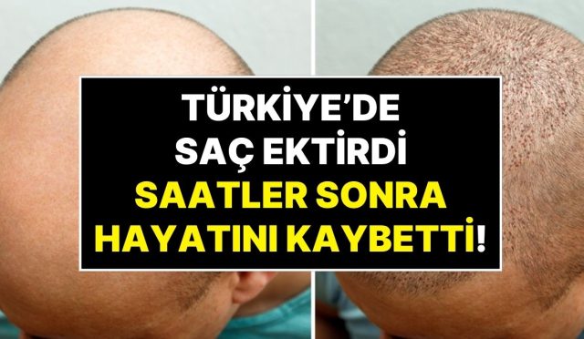 ingiltereden-turkiyeye-sac-ektirmeye-gelen-hasta-ameliyat-sonrasi-hayatini-kaybetti-MSvduJRp.jpg
