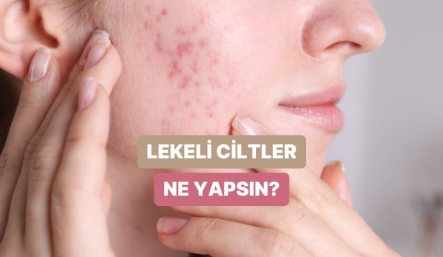 leke-gorunumune-sahip-ciltlerin-uygulamasi-gereken-tesirli-bakim-rutini-teklifleri-MJbgNwx2.jpg